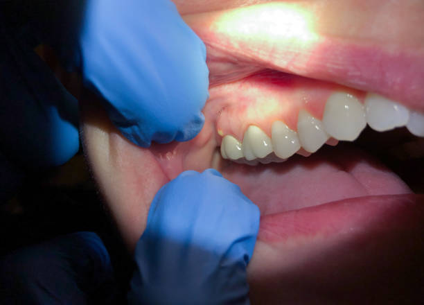 Best Emergency Root Canal Treatment in Salem, SD